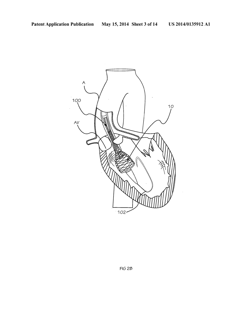 Methods and Apparatus for Performing Valvuloplasty - diagram, schematic, and image 04