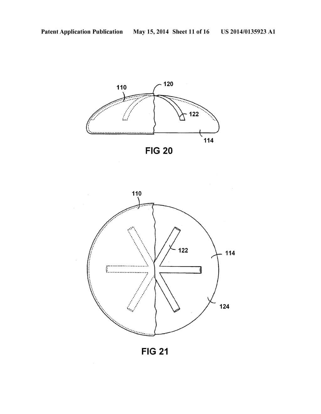 BREAST IMPLANT WITH INTERNAL FLOW DAMPENING - diagram, schematic, and image 12