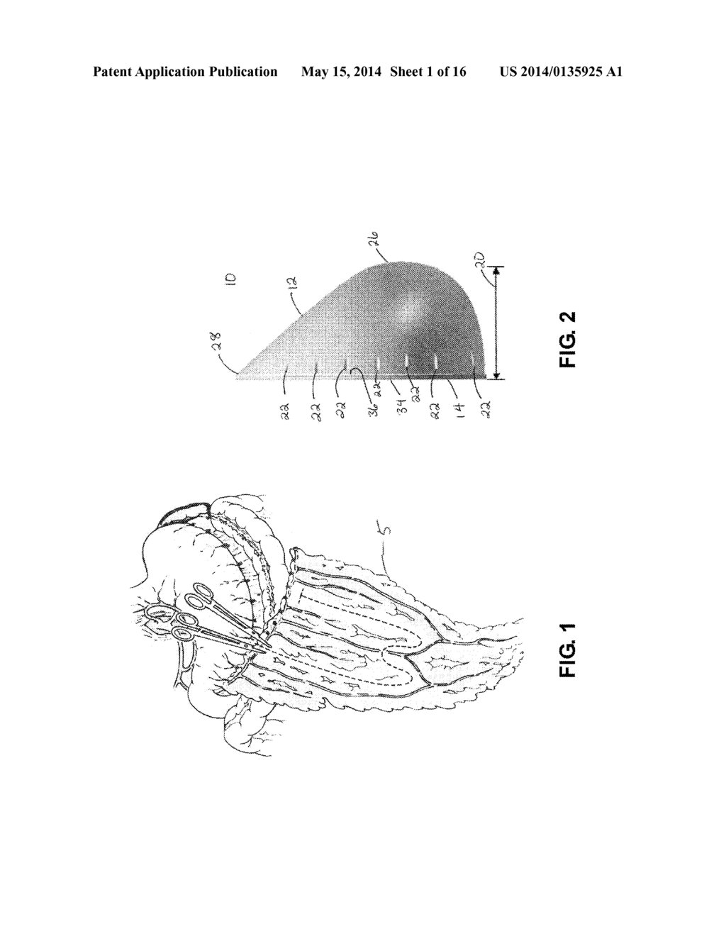 Breast Reconstruction Device and Methods - diagram, schematic, and image 02