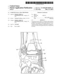 STABILIZED TOTAL ANKLE PROSTHESIS diagram and image