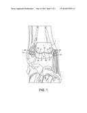 STABILIZED TOTAL ANKLE PROSTHESIS diagram and image