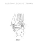 STABILIZED TOTAL ANKLE PROSTHESIS diagram and image