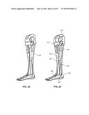 MODULAR PROSTHETIC SOCKETS AND METHODS FOR MAKING SAME diagram and image