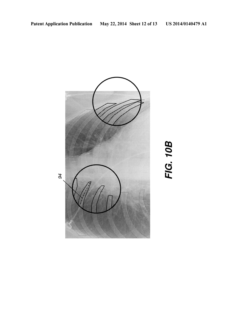 HYBRID DUAL ENERGY IMAGING AND BONE SUPPRESSION PROCESSING - diagram, schematic, and image 13