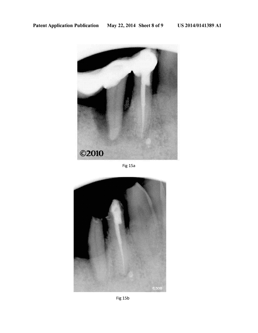 LASER ASSISTED PERIODONTIUM AND OSSEUS REGENERATION PROTOCOL - diagram, schematic, and image 09