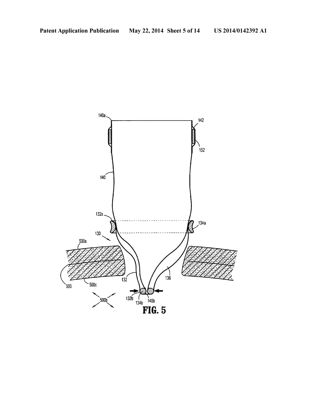 SURGICAL ACCESS ASSEMBLY WITH SLEEVE AND ADJUSTABLE FASTENER - diagram, schematic, and image 06