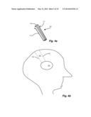 FLEXIBLE SURGICAL SHEATH AND MULTI-PART INSERTION CANNULA diagram and image