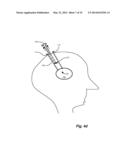 FLEXIBLE SURGICAL SHEATH AND MULTI-PART INSERTION CANNULA diagram and image