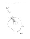 FLEXIBLE SURGICAL SHEATH AND MULTI-PART INSERTION CANNULA diagram and image