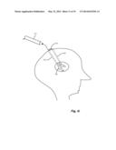 FLEXIBLE SURGICAL SHEATH AND MULTI-PART INSERTION CANNULA diagram and image