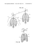 PATIENT MOVEMENT COMPENSATION IN INTRA-BODY PROBE diagram and image