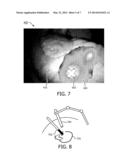 SYSTEM AND METHOD FOR GUIDED INJECTION DURING ENDOSCOPIC SURGERY diagram and image