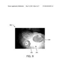 SYSTEM AND METHOD FOR GUIDED INJECTION DURING ENDOSCOPIC SURGERY diagram and image