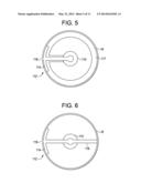 Minimally Invasive Method for Coronary Bypass and Other Treatments diagram and image