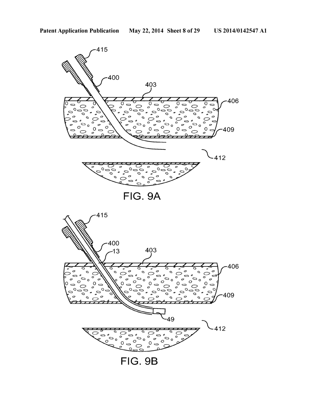 HEMOSTATSIS-ENHANCING DEVICE AND METHOD FOR ITS USE - diagram, schematic, and image 09