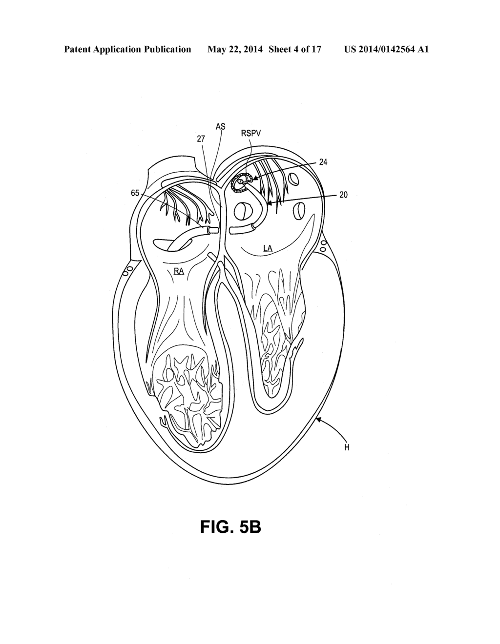 ABLATION THERAPY SYSTEM AND METHOD FOR TREATING CONTINUOUS ATRIAL     FIBRILLATION - diagram, schematic, and image 05