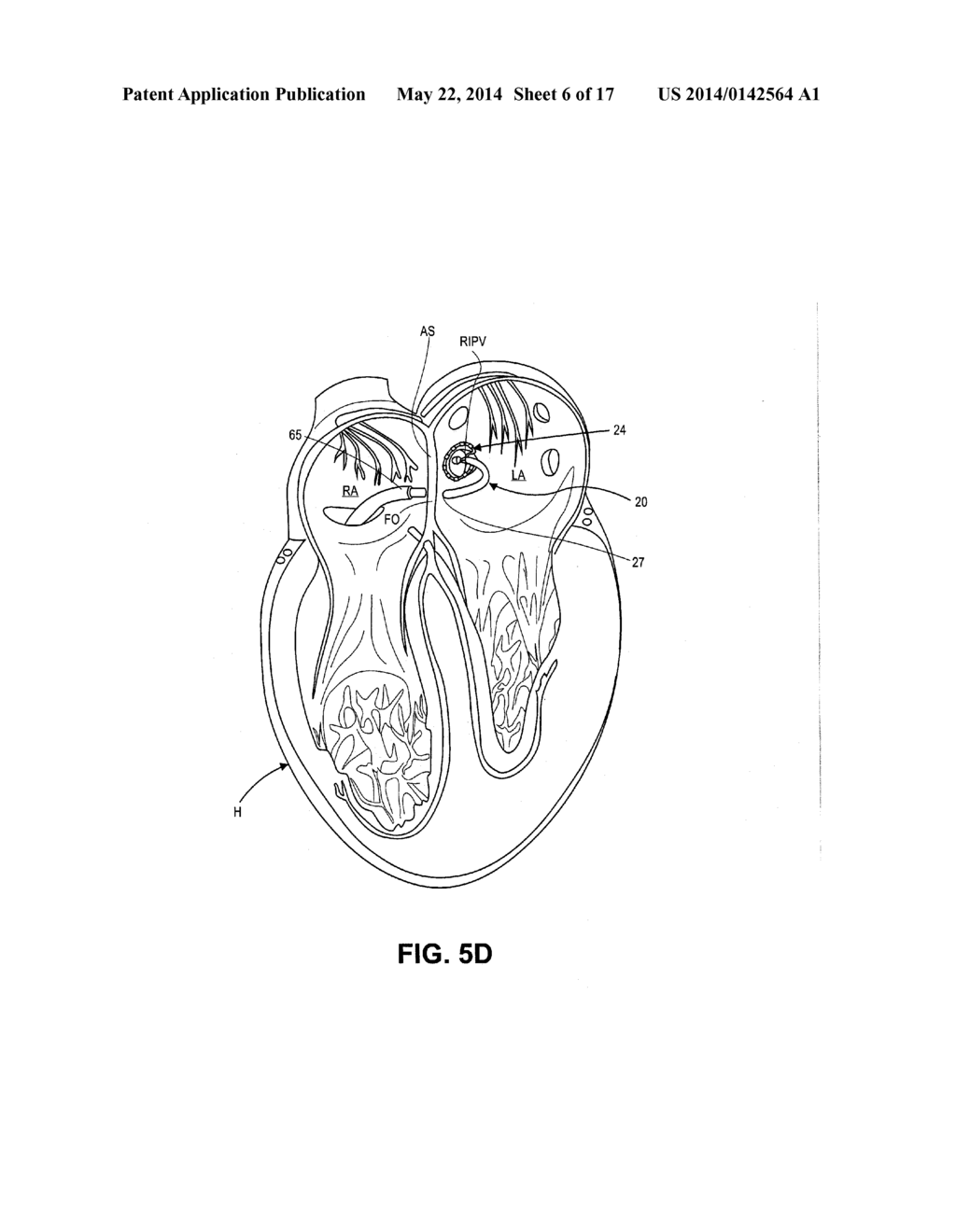 ABLATION THERAPY SYSTEM AND METHOD FOR TREATING CONTINUOUS ATRIAL     FIBRILLATION - diagram, schematic, and image 07