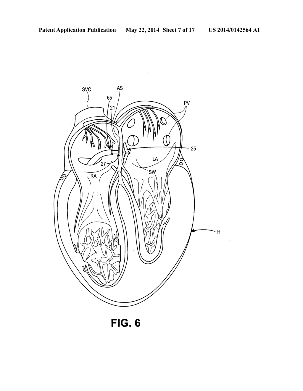 ABLATION THERAPY SYSTEM AND METHOD FOR TREATING CONTINUOUS ATRIAL     FIBRILLATION - diagram, schematic, and image 08