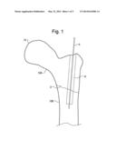 MULTICHANNEL CANNULA  AND METHODS FOR USING SAME diagram and image