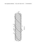 Temporary Vascular Scaffold and Scoring Device diagram and image