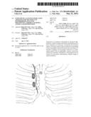 Sympathetic ganglion stimulation apparatus for treatment of hyperhidrosis,     Raynauds phenomenon, cerebral ischemia, asthma and hypertension diagram and image