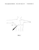 Sympathetic ganglion stimulation apparatus for treatment of hyperhidrosis,     Raynauds phenomenon, cerebral ischemia, asthma and hypertension diagram and image