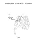 Sympathetic ganglion stimulation apparatus for treatment of hyperhidrosis,     Raynauds phenomenon, cerebral ischemia, asthma and hypertension diagram and image