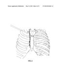 Sympathetic ganglion stimulation apparatus for treatment of hyperhidrosis,     Raynauds phenomenon, cerebral ischemia, asthma and hypertension diagram and image