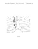 Sympathetic ganglion stimulation apparatus for treatment of hyperhidrosis,     Raynauds phenomenon, cerebral ischemia, asthma and hypertension diagram and image