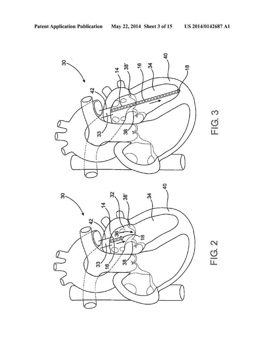 DEVICE AND METHOD OF TREATING HEART VALVE MALFUNCTION - diagram, schematic, and image 04