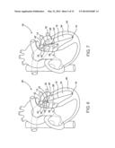 DEVICE AND METHOD OF TREATING HEART VALVE MALFUNCTION diagram and image