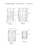 Stents For Prosthetic Heart Valves diagram and image