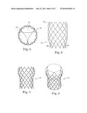 Stents For Prosthetic Heart Valves diagram and image