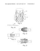 Stents For Prosthetic Heart Valves diagram and image