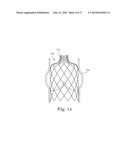 Stents For Prosthetic Heart Valves diagram and image