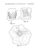 Stents For Prosthetic Heart Valves diagram and image