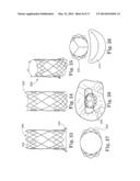 Stents For Prosthetic Heart Valves diagram and image