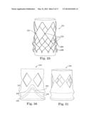 Stents For Prosthetic Heart Valves diagram and image