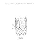 Stents For Prosthetic Heart Valves diagram and image