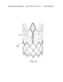 Stents For Prosthetic Heart Valves diagram and image