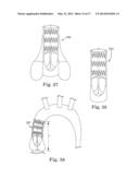 Stents For Prosthetic Heart Valves diagram and image