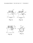 Stents For Prosthetic Heart Valves diagram and image