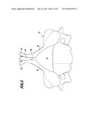 SURGICAL IMPLANT FOR WIDENING A VERTEBRAL CANAL diagram and image