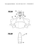 SURGICAL IMPLANT FOR WIDENING A VERTEBRAL CANAL diagram and image