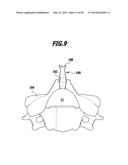 SURGICAL IMPLANT FOR WIDENING A VERTEBRAL CANAL diagram and image