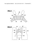 SURGICAL IMPLANT FOR WIDENING A VERTEBRAL CANAL diagram and image