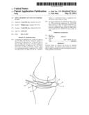 Joint Arthroplasty Devices Formed In Situ diagram and image