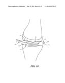 Joint Arthroplasty Devices Formed In Situ diagram and image