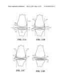 Joint Arthroplasty Devices Formed In Situ diagram and image