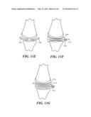 Joint Arthroplasty Devices Formed In Situ diagram and image